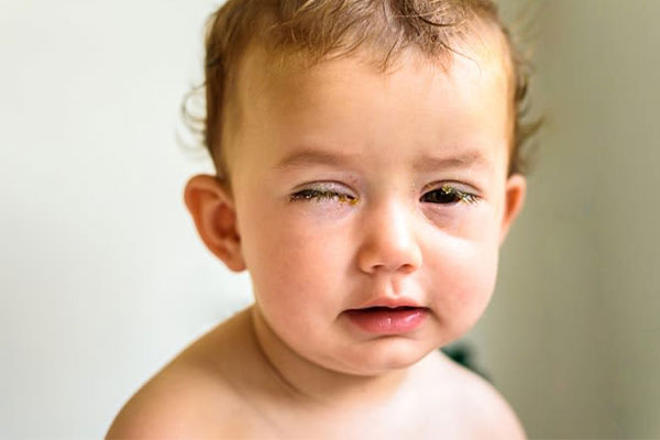 Home treatment of eye pain in children