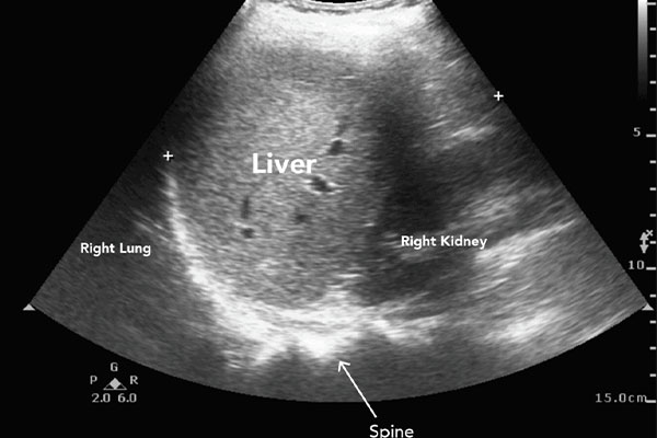 Steps of liver ultrasound
