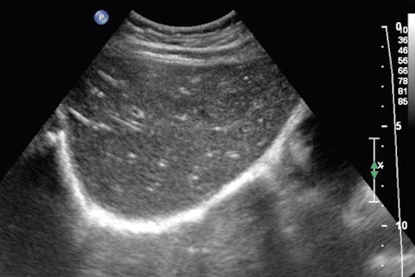 What is a liver ultrasound?