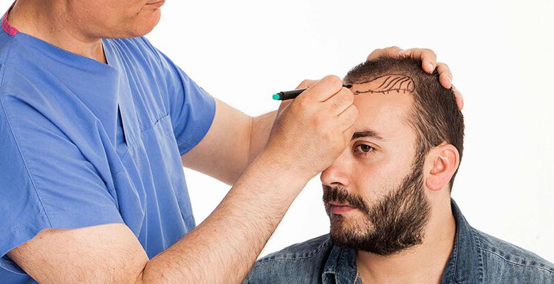 Dos and don'ts of hair care after transplant