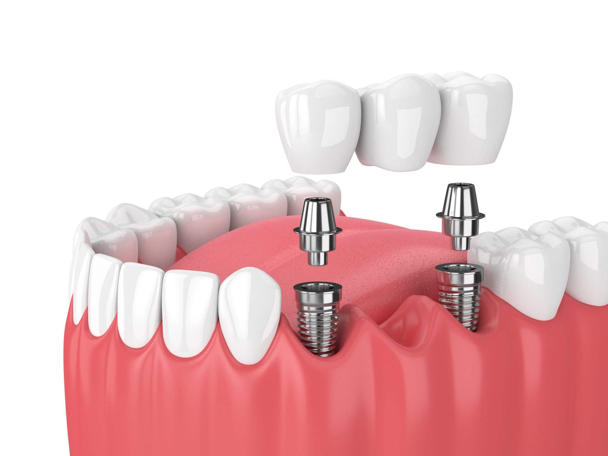 What are the complications of dental implants?