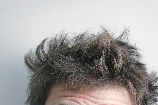 Symptoms of hair loss