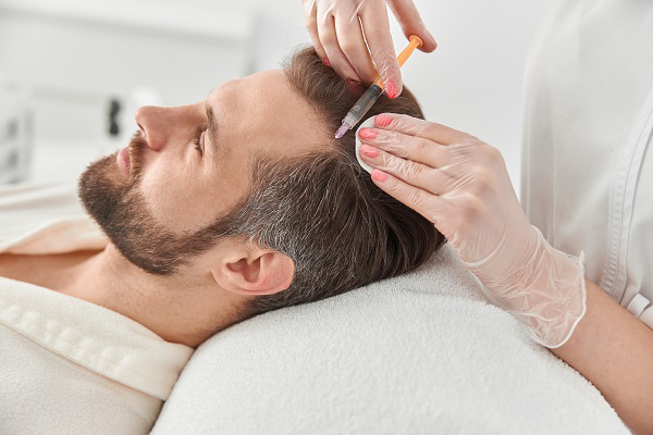 Mesotherapy for the treatment of male hormonal hair loss